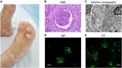 Glomerular IgA Deposition and Serum Antineutrophil Cytoplasmic Antibody Positivity in a Child With Dystrophic Epidermolysis Bullosa: Case Report and Literature Review